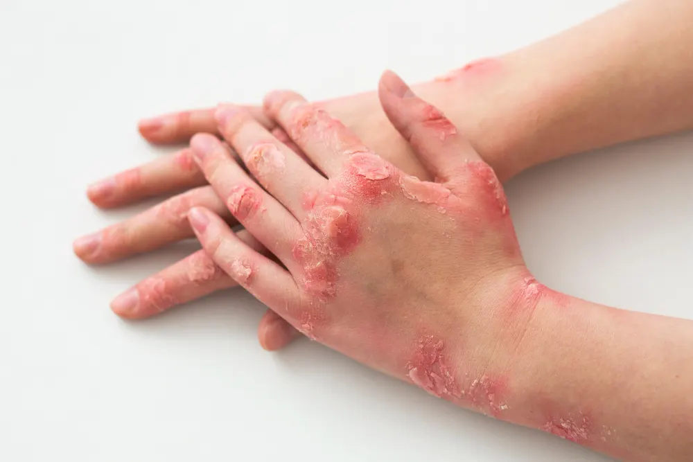 hands-of-patient-suffering-from-psoriasis