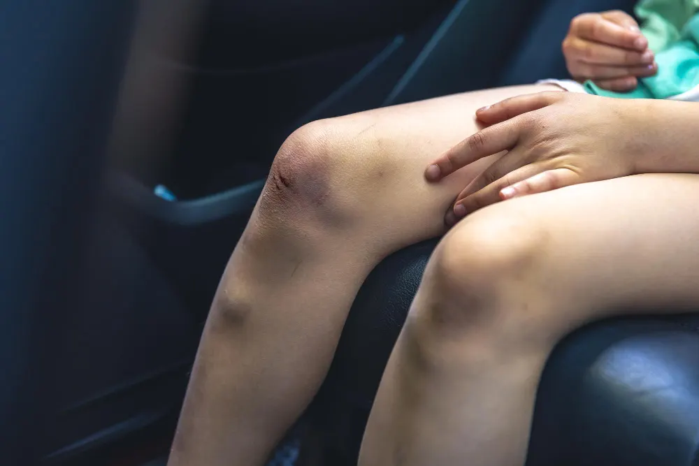 closeup-little-girl-holding-her-bruised-injured-damaged-knee-with-her-hands