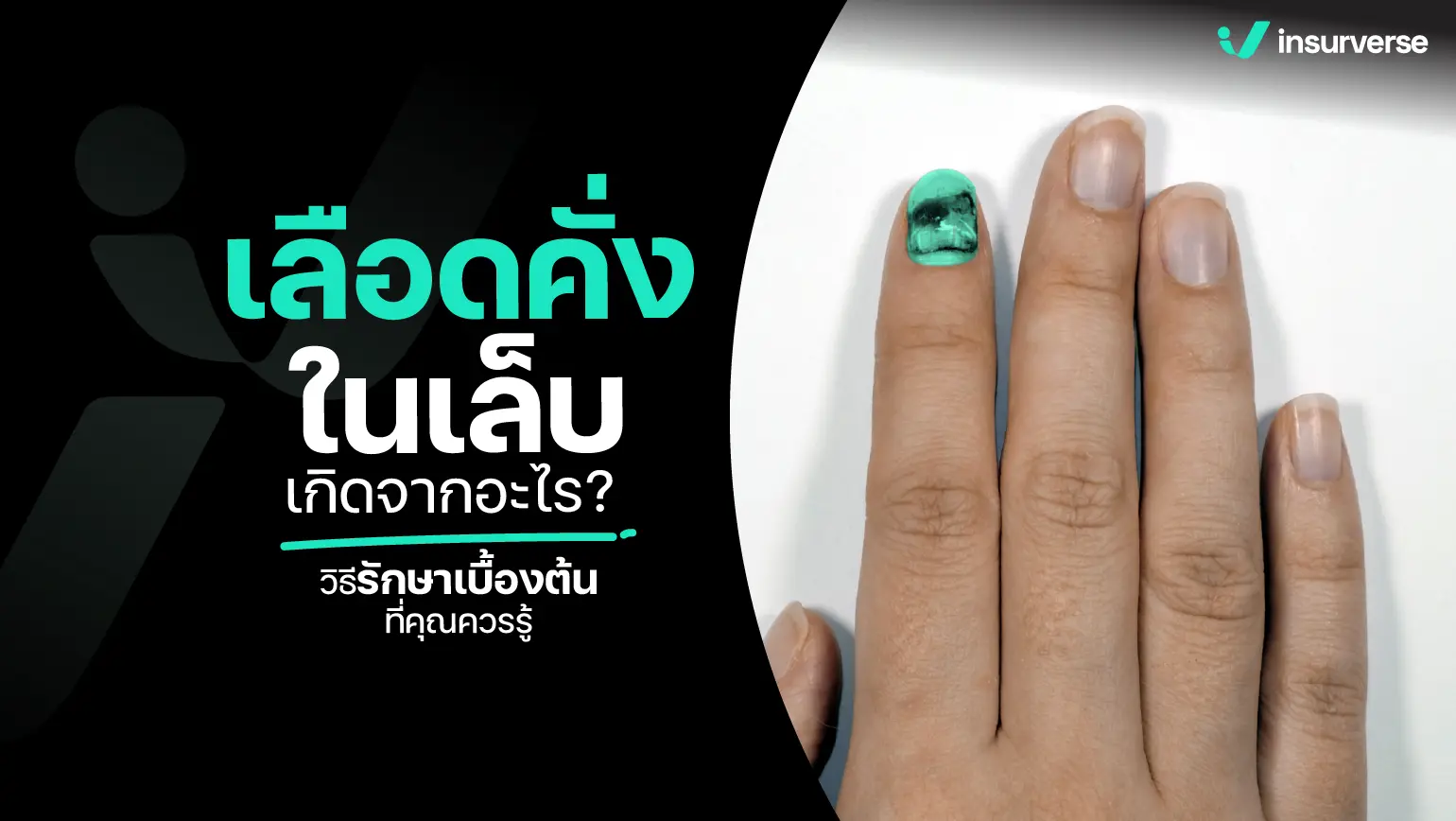 เลือดคั่งในเล็บเกิดจากอะไร? วิธีรักษาเบื้องต้นที่คุณควรรู้